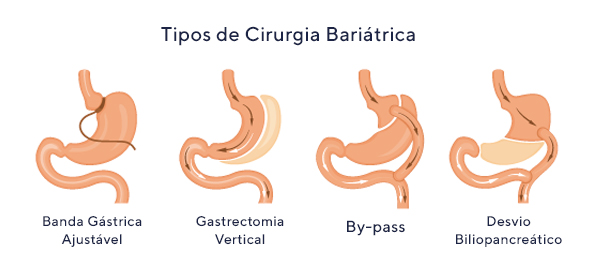 Cirurgia bariátrica: 6 fatos importantes para você saber - Clínica Láparos