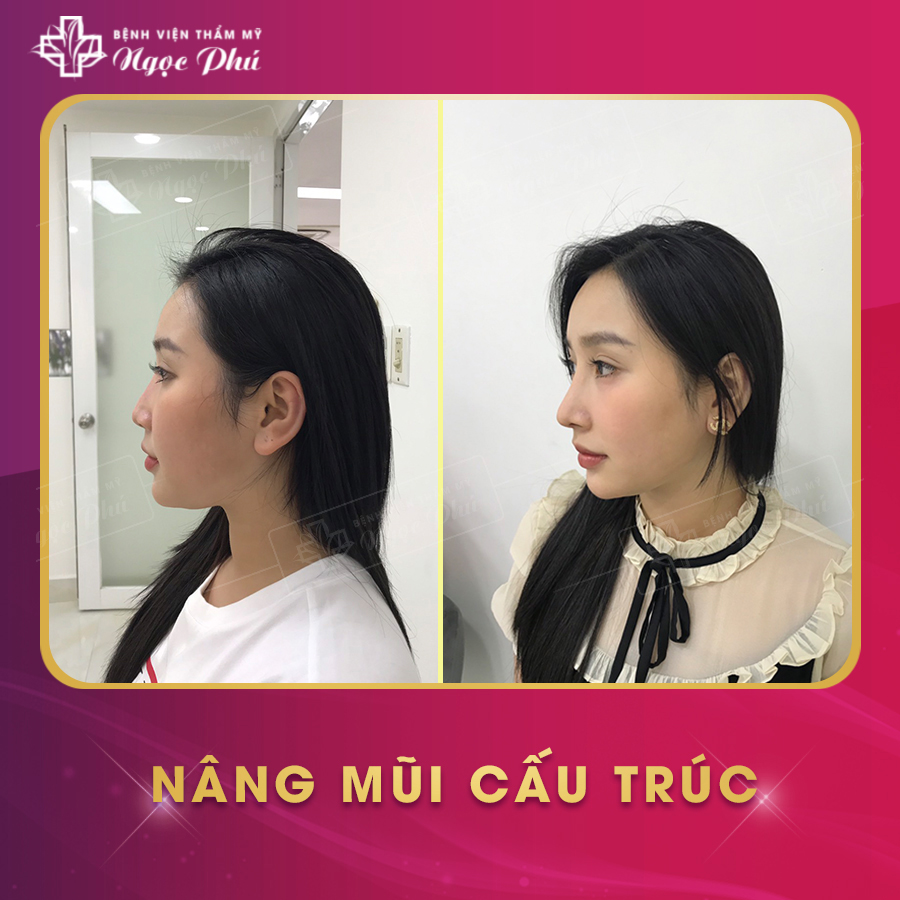 Công nghệ nâng mũi mới nhất tại Bệnh viện Thẩm mỹ Ngọc Phú.