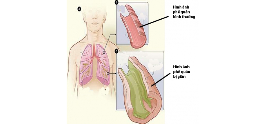 Giãn phế quản