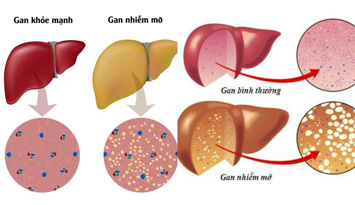 men gan cao có nguy hiểm không