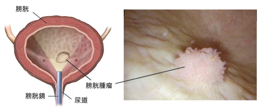 健康揭泌-泌尿-膀胱癌