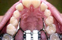 Opened mouth expansion therapy Opened mouth expansion therapy