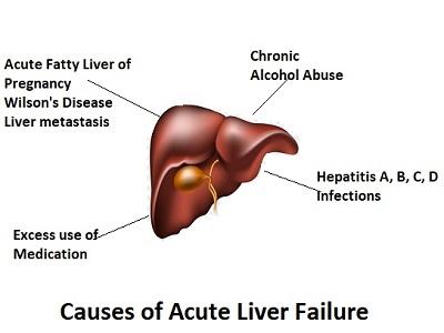 Acute Liver Failure specialist in South Mumbai | Acute Liver Failure doctor in Mumbai, Maharashtra.