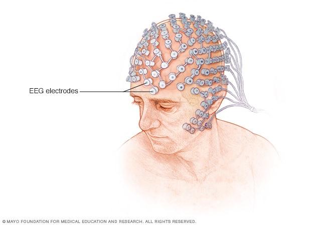 EEG (electroencephalogram) - Mayo Clinic