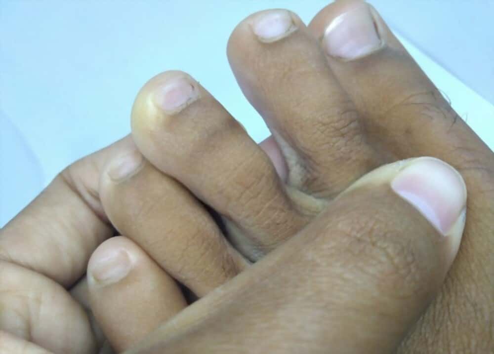 Mineral deficiency causes nail damage