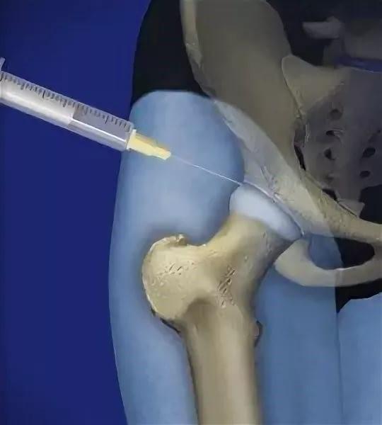 A syringe injecting a bone

Description automatically generated