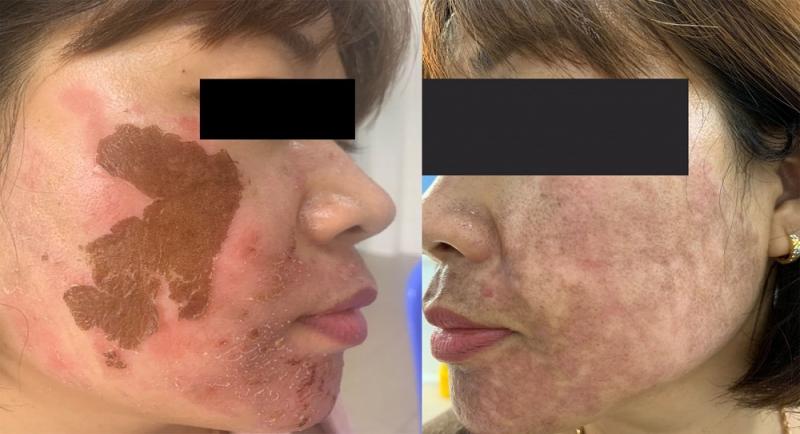 CẢNH BÁO BIẾN CHỨNG DO TRỊ NÁM SAI CÁCH VÀ PHƯƠNG PHÁP BẮN LASER TRỊ NÁM 2 phương pháp bắn laser trị nám