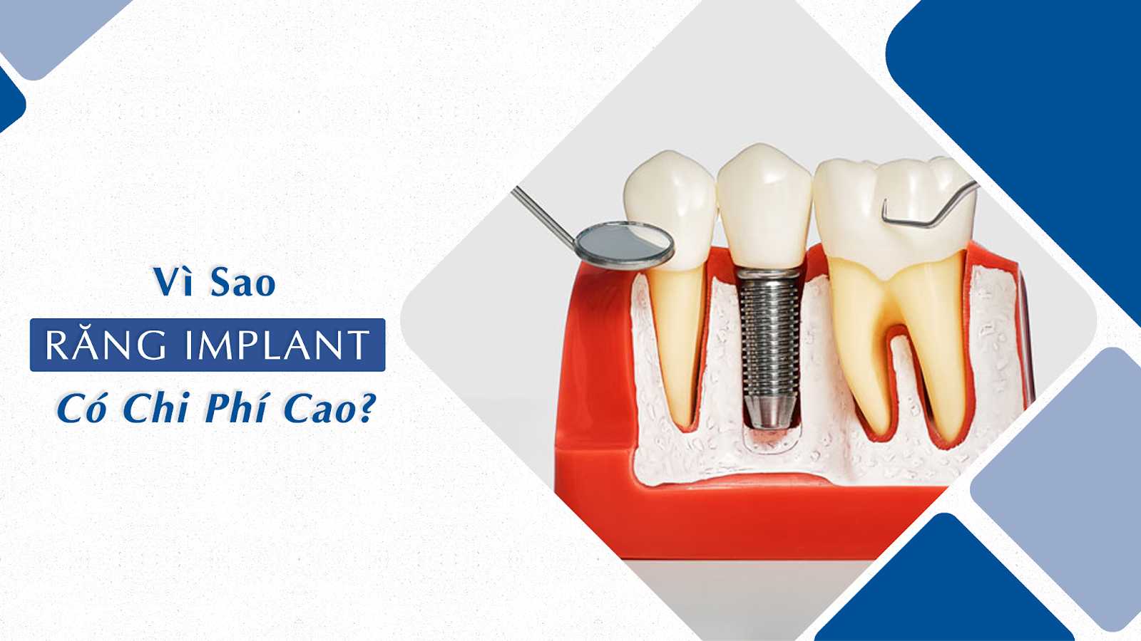 Vì sao trồng răng Implant lại có chi phí cao?