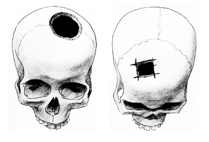 Trephinations la) Round trephination, Jericho, Qaranthal lb) Angular... |  Download Scientific Diagram