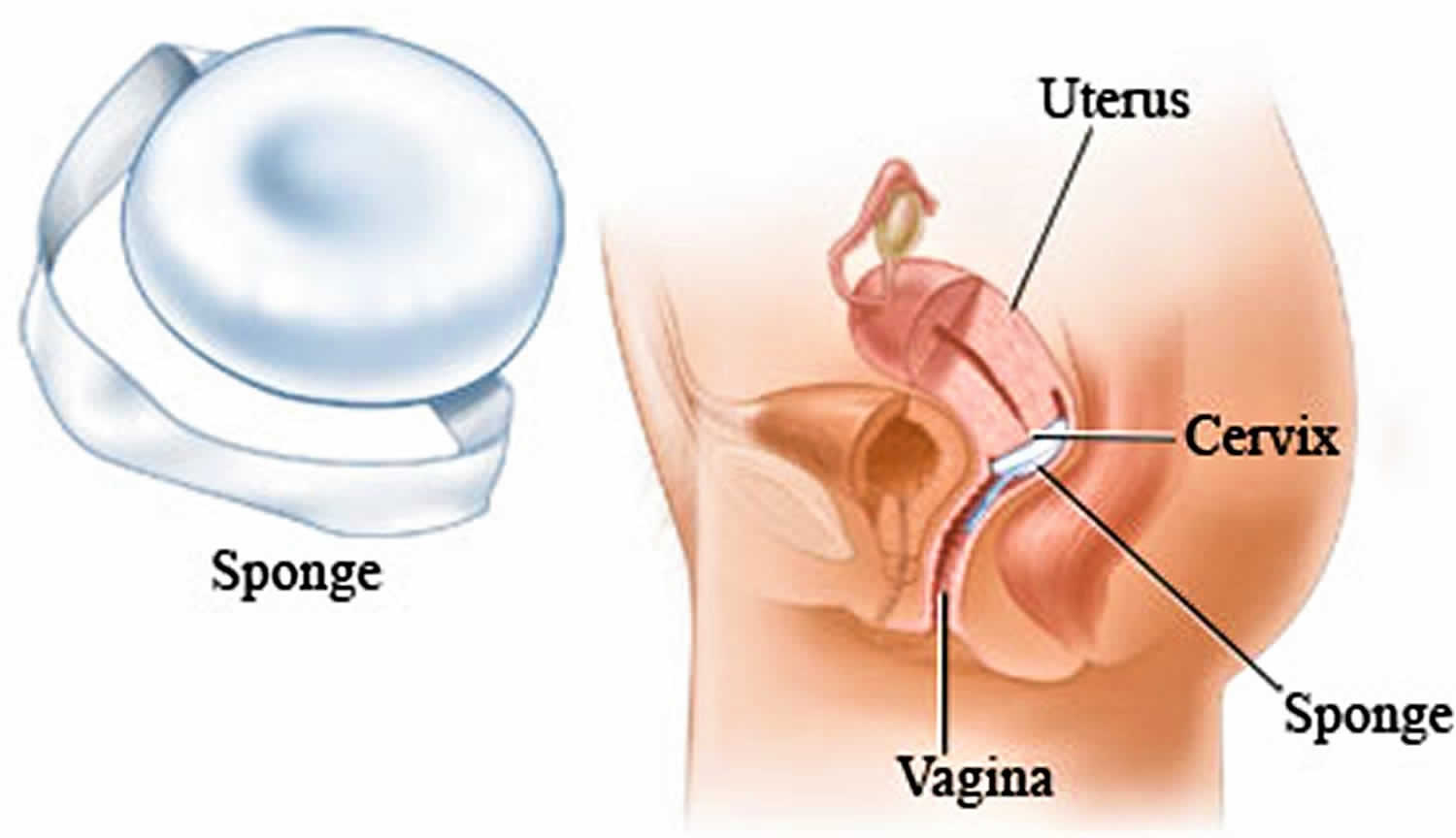 Image result for birth control sponge