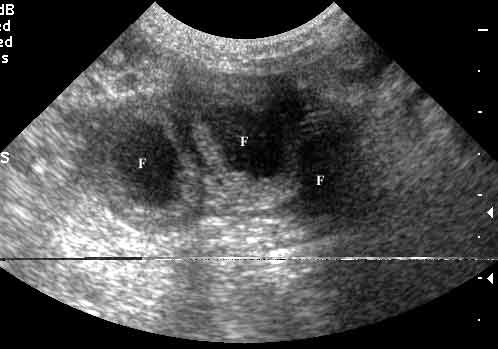 Sonograma de 3 secciones transversas del cuerno uterino de una perra Corgi de 12 años de edad, que se colapsó y entró en shock