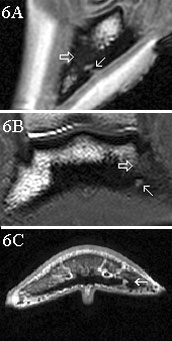 (A) Sagittal SPGR, (B) dorsal T2* GRE, and (C) transverse STIR MRIs of Case 5. Medial is to the right in B and C.