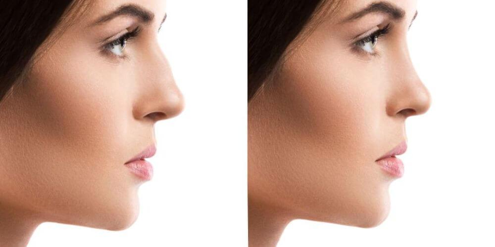 Images avant et après une chirurgie du nez
