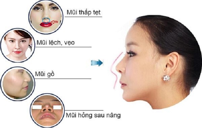 Phương pháp nâng mũi sụn sườn giúp dáng mũi đẹp tự nhiên