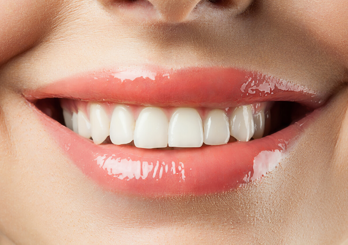 teeth whitening in Vancouver
