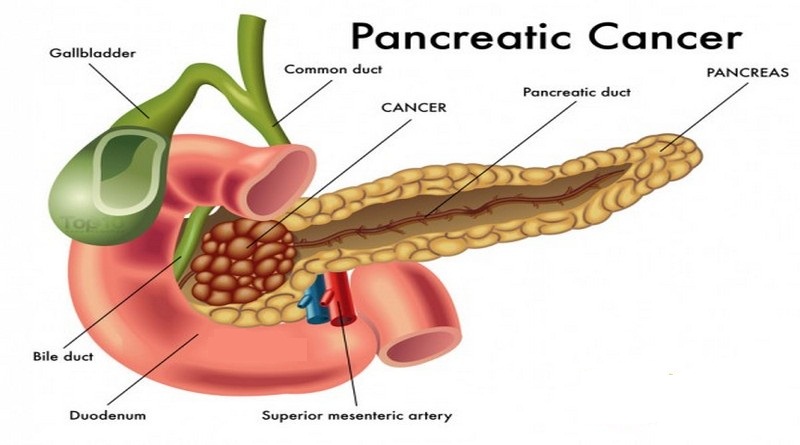 pancreatic-cancer-diag-600x461-1-1.jpg