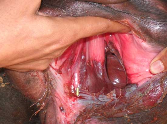 A postpartum buffalo with vaginal rupture.