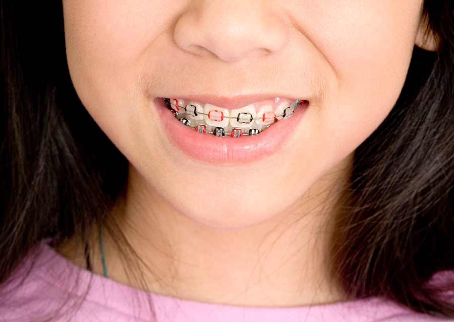 Adolescent orthodontic care. Adolescent orthodontic care.