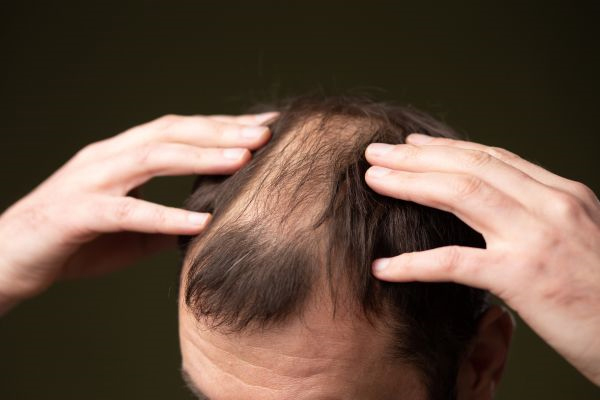 Male Pattern Hair loss - Balding on top of head