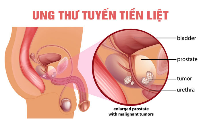 điều trị ung thư tuyến tiền liệt