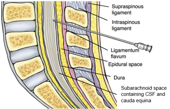 Lumbar Puncture (Spinal Tap) – Technique and Overview - The Procedure Guide