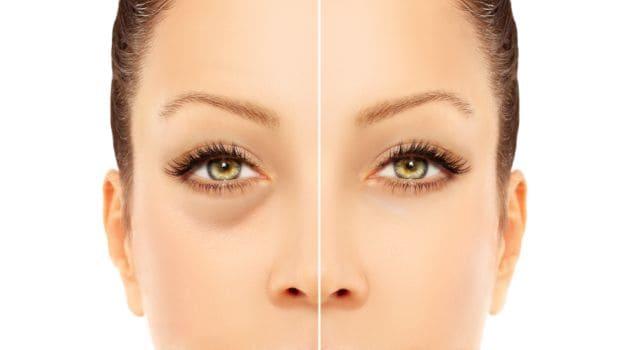 5 Natural Home Remedies to Remove Dark Circles - NDTV Food