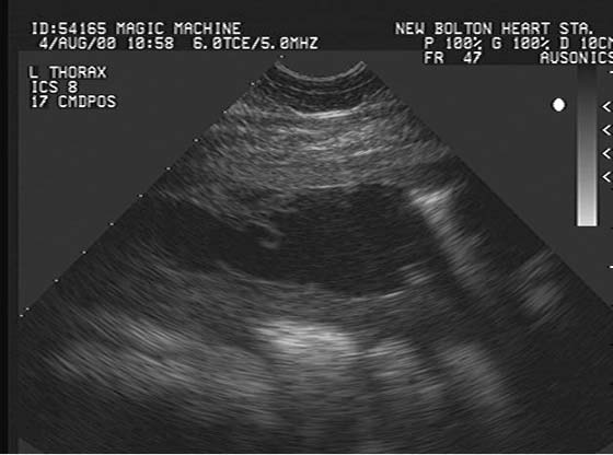Sonographic appearance of fibrin on visceral and parietal pleura in horse with severe pleuropneumonia.