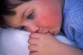 Scarlet fever is a contagious bacterial infection that primarily affects children. It is caused by the same bacteria that causes strep throat, and it is spread through contact with an infected person or through contact with the bacteria in the air. While the infection can be serious, it is usually treatable with antibiotics.   