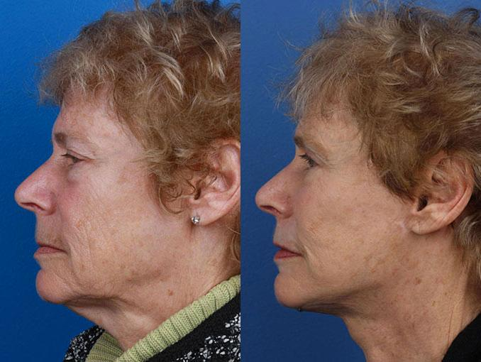 deep plane facelift results new york