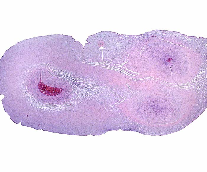 Umbilical cord with two arteries (right) and vein at left. At arrow is the tiny remains of a former allantoic duct. The surface is covered with amnionic epithelium.