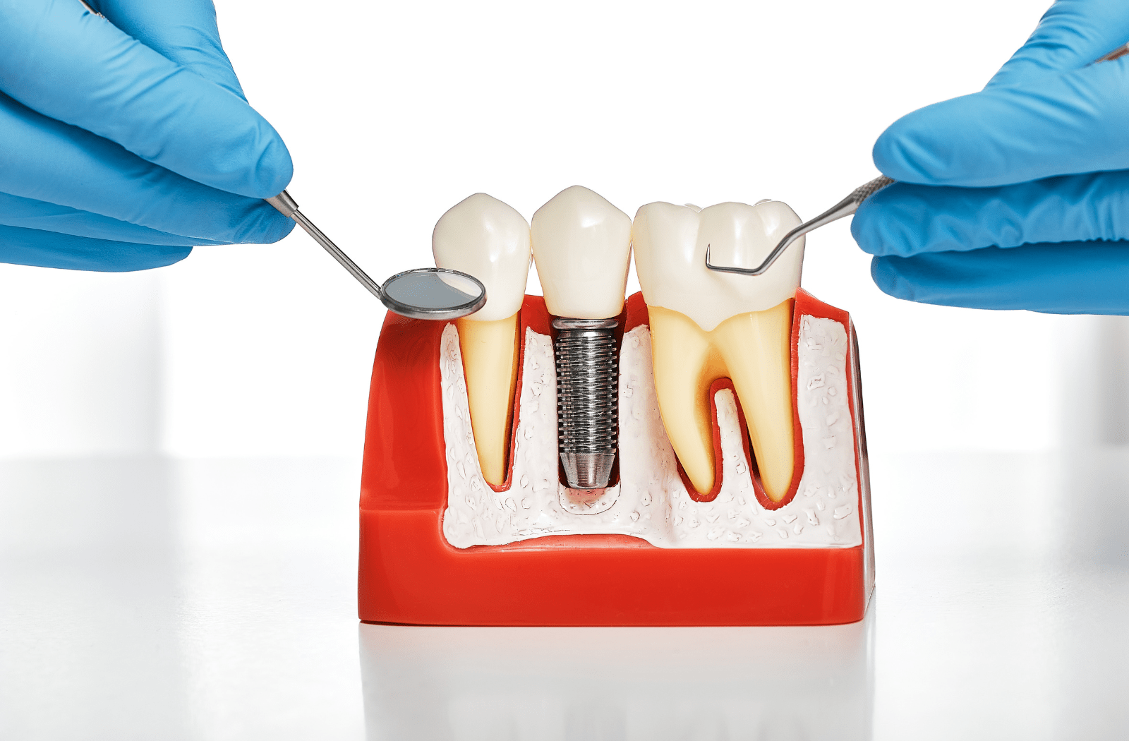 A dentist uses dental tools near a plastic model of teeth with a dental implant present in the middle to show what a dental implant looks like