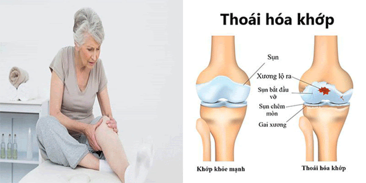 Thái hóa khớp là gì