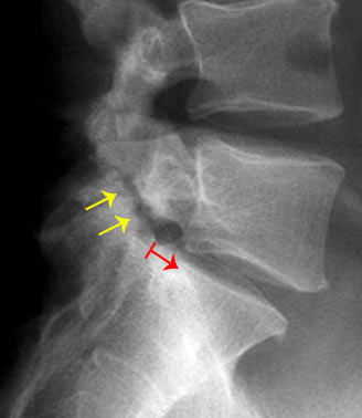 Pediatric Spondylolisthesis & Spondylolysis - Spine - Orthobullets