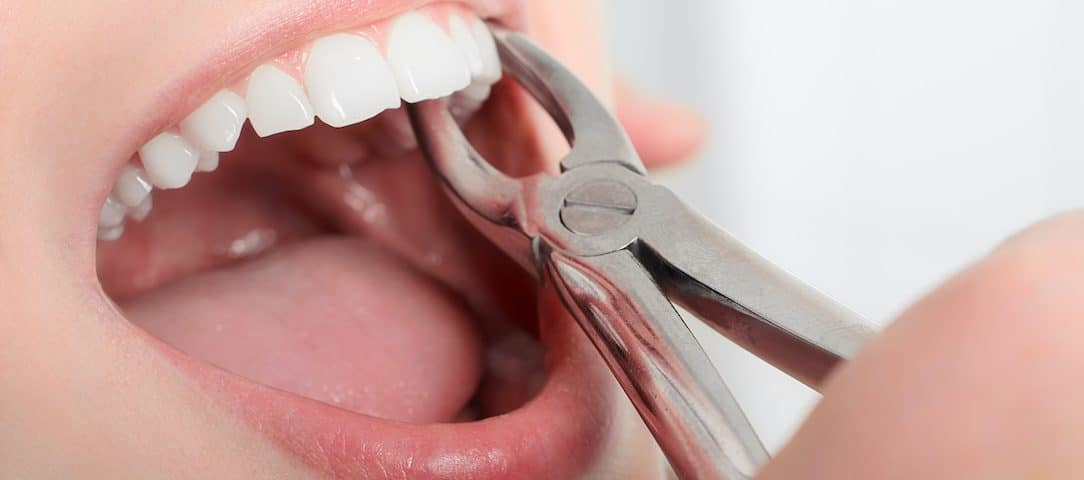 Tooth Extraction - All You Need to Know