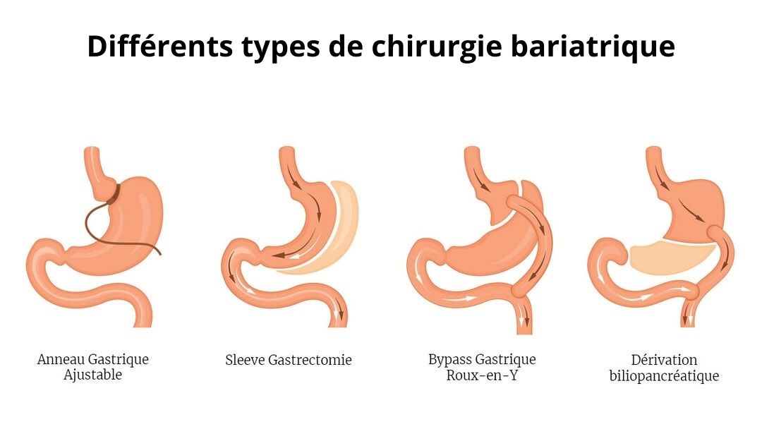 types de chirurgie bariatrique