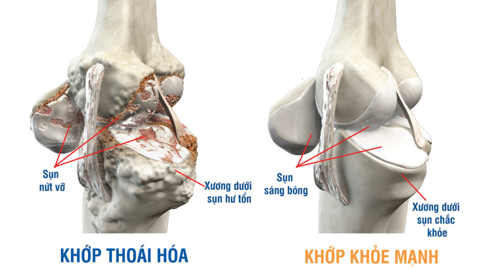 Thái hóa khớp là gì
