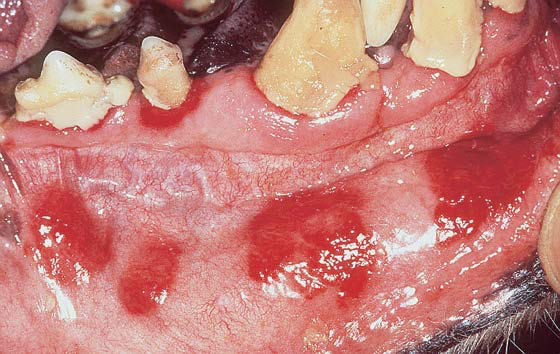Oral lesions in uremic stomatitis/gingivitis