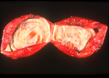 Photograph of a granulosa cell tumor comprised of a single large cyst.
