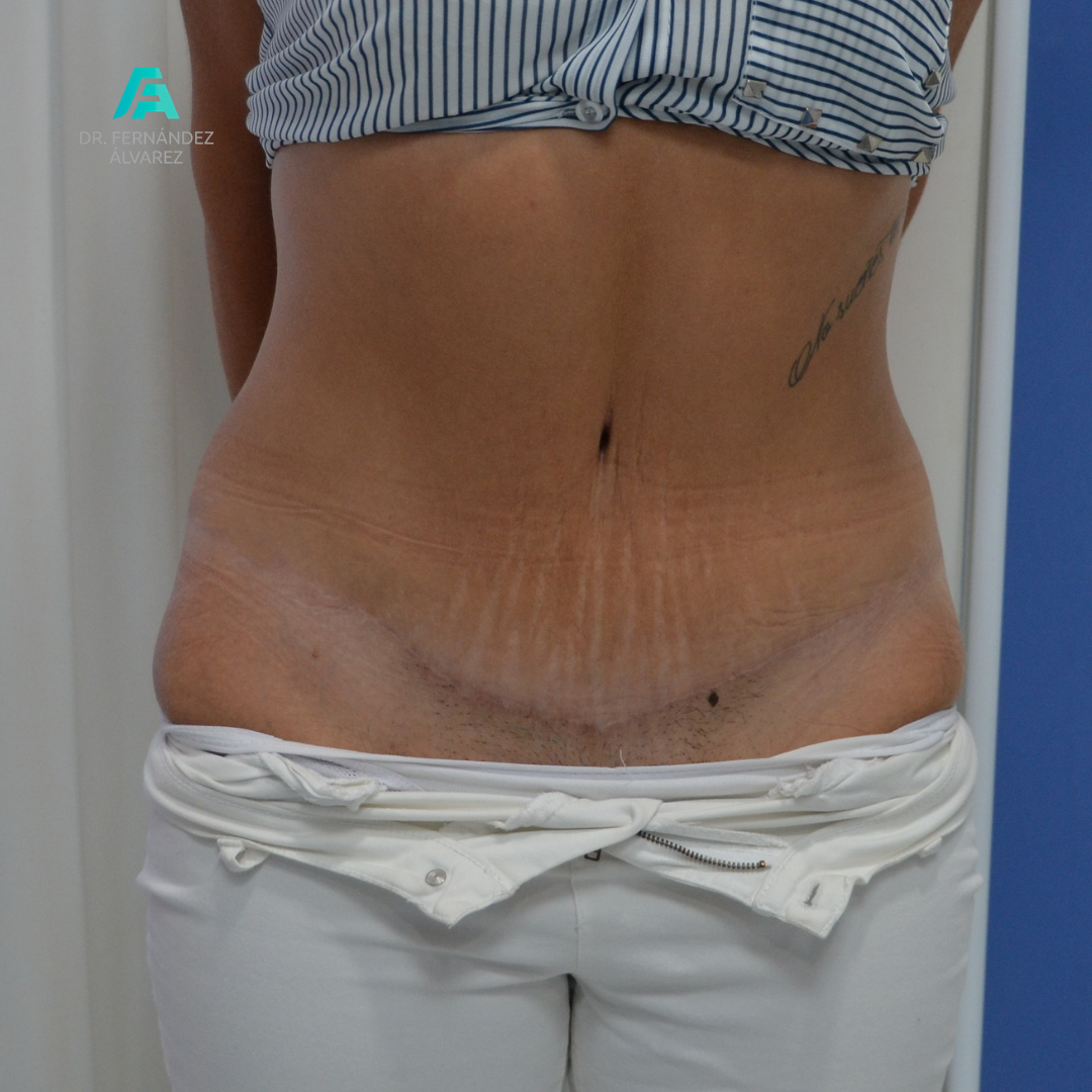 Antes y después de una abdominoplastia: proceso y postoperatorio - Dr.  Fernández Álvarez