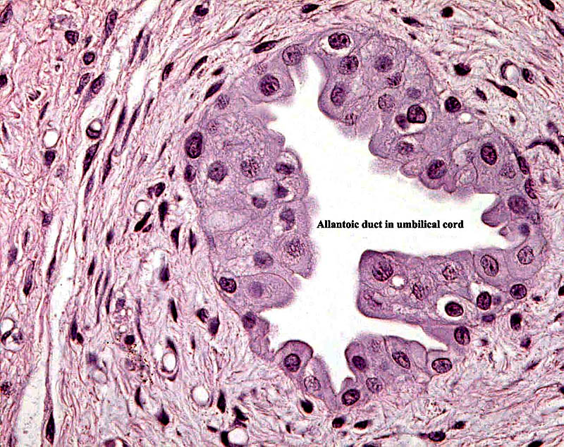 Allantoic duct in umbilical cord