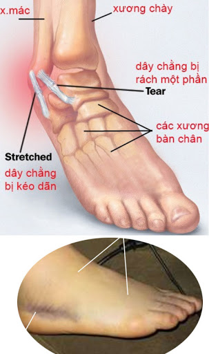 Hình ảnh bong gân cổ chân