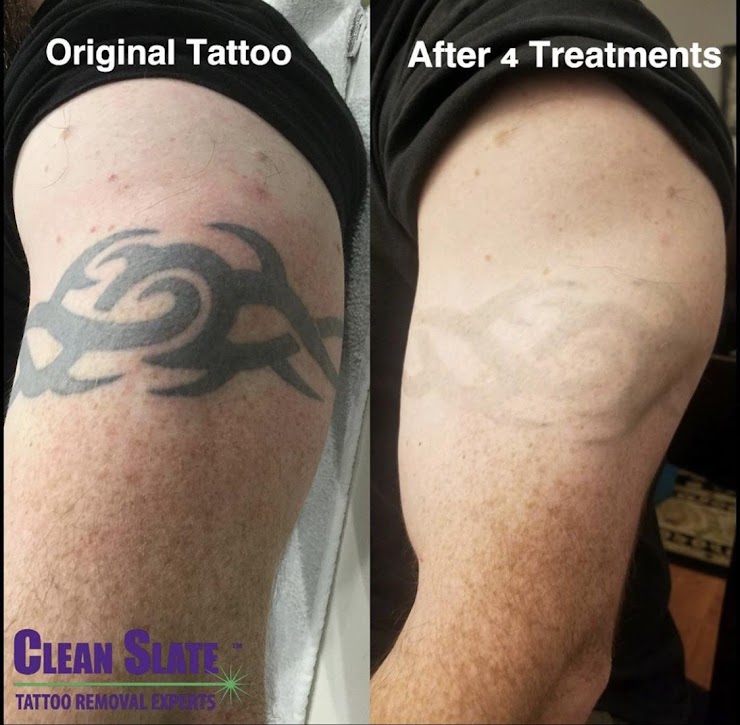 Guest Spot and Tattoo Removal