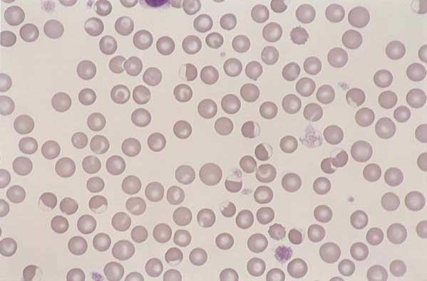 Canine blood. Hemolytic disease. RBC with eccentric hemoglobin staining...