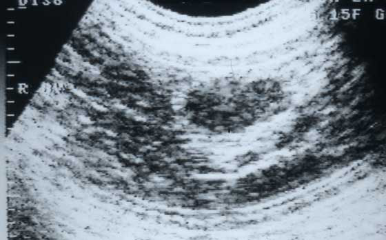 Ultrasonograma trans-abdominal de una perra que muestra un ovario 1 día después de la ovulación, sin la evidencia de estructuras anecoicas esféricas distintivas presentes 1 a 2 días antes