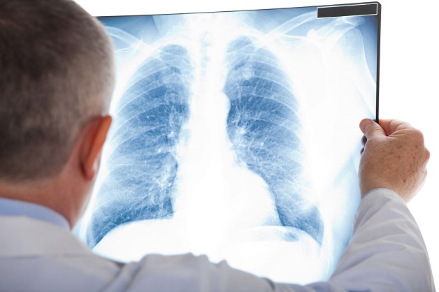 dấu hiệu ung thư phổi,dấu hiệu ung thư phổi giai đoạn đầu,dấu hiệu ung thư phổi giai đoạn 1,dấu hiệu ung thư phổi giai đoạn 2,dấu hiệu ung thư phổi giai đoạn cuối