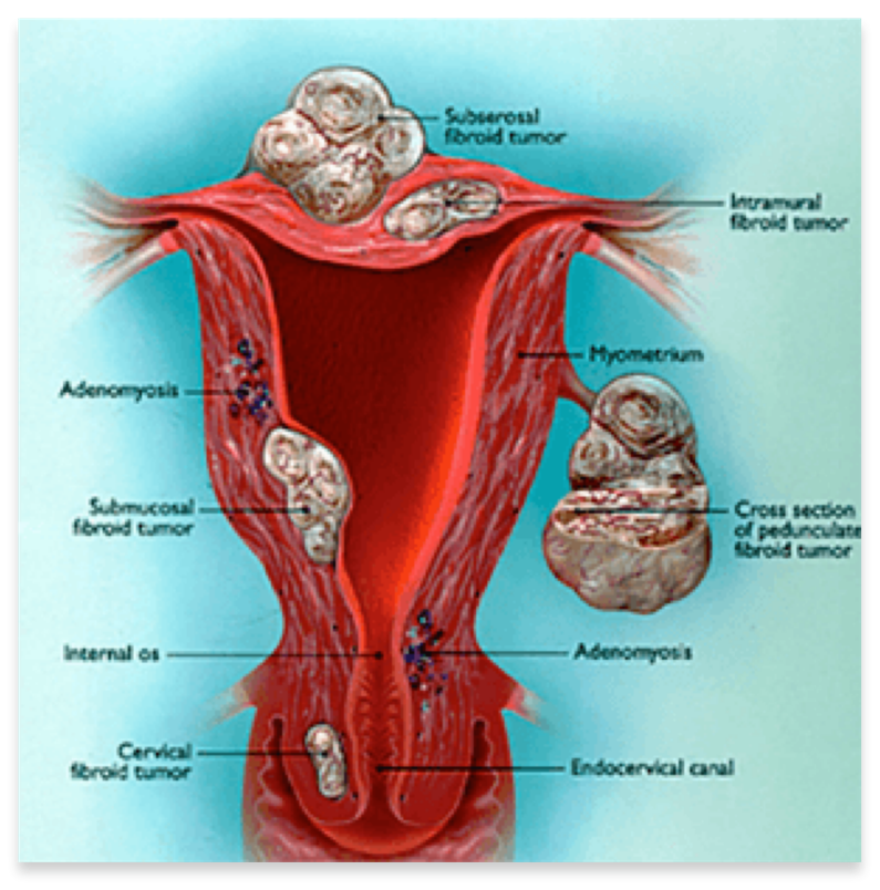 Fibroids