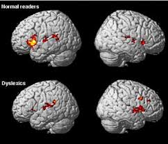 Image result for brain scan dyslexia