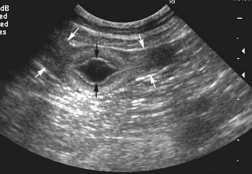 Día 23, vesícula sin embrión visible, en un plano longitudinal