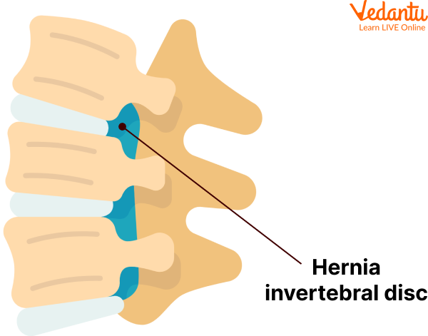 Intervertebral Disk