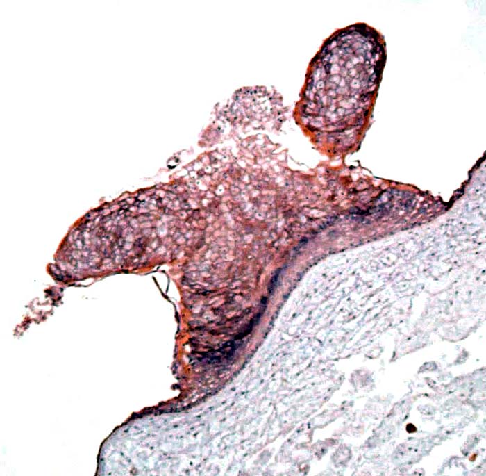 Areas of squamous metaplasia of the cord. 